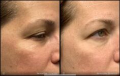 before and after non-abrasive laser resurfacing right side view case 862