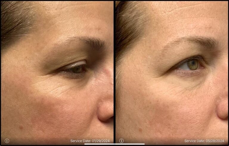 before and after non-abrasive laser resurfacing right side view case 862