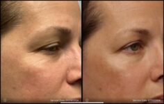 before and after non-abrasive laser resurfacing right side view case 862 2