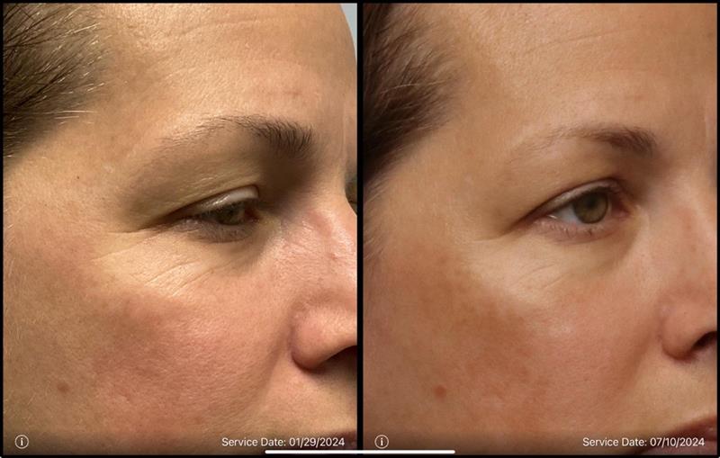 before and after non-abrasive laser resurfacing right side view case 862 2