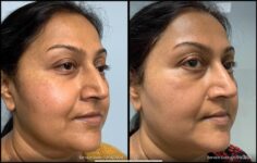 before and after non-abrasive laser resurfacing cheek view case 865