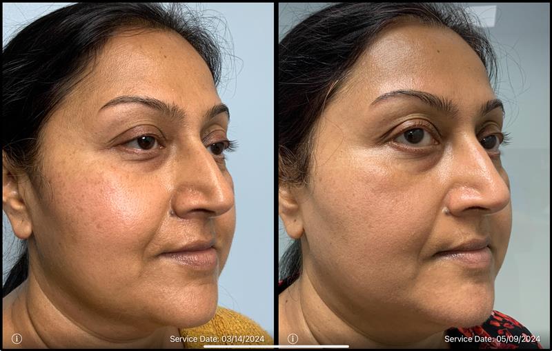 before and after non-abrasive laser resurfacing cheek view case 865