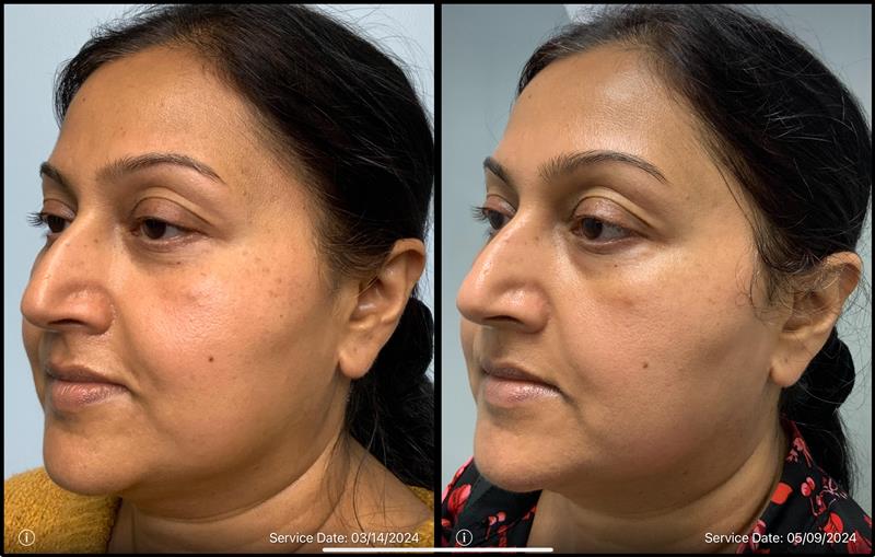 before and after non-abrasive laser resurfacing left front view case 865