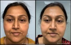 before and after non-abrasive laser resurfacing front view case 865