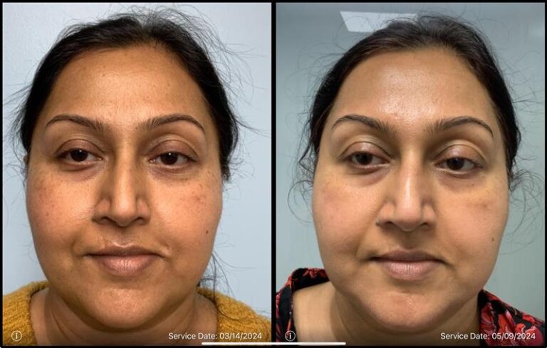 before and after non-abrasive laser resurfacing front view case 865