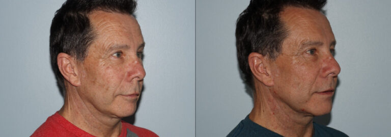 before and after non-abrasive laser resurfacing male cheek view case 869