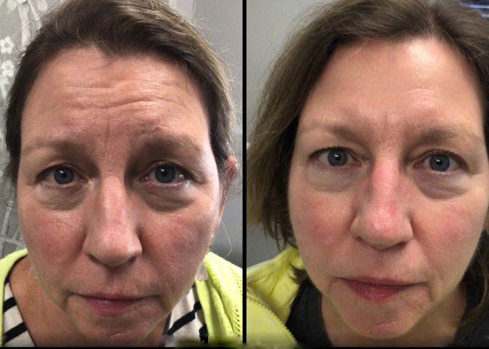 before and after neuromodulator female patient case 845