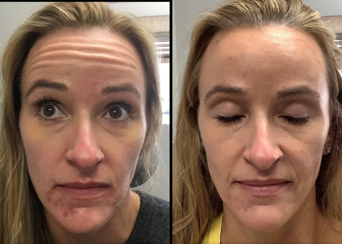 before and after neuromodulators female patient front view case 849