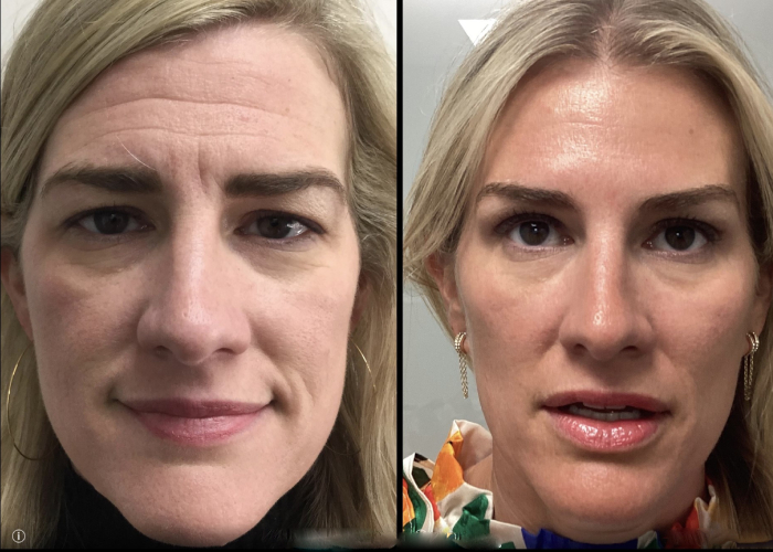 before and after neuromodulators female patient front view case 850