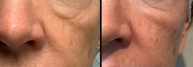 before and after non-abrasive laser resurfacing cheek view case 872