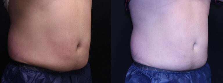 before and after right angle view male Body Contouring Case 918
