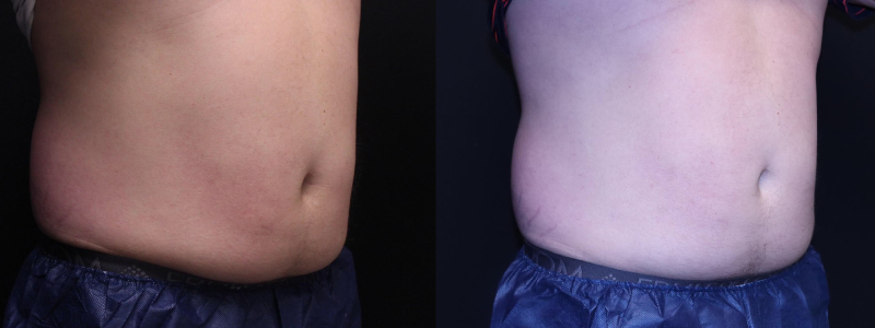 before and after right angle view male Body Contouring Case 918