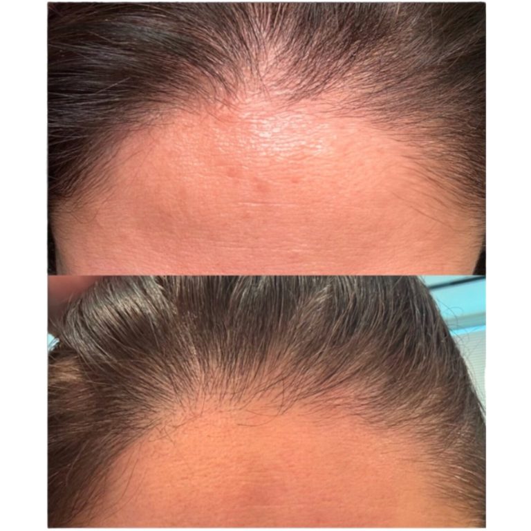 Female. Pro-Xo Premium Hair Exosomes. 3 Weeks Post-Microneedling Treatment #2