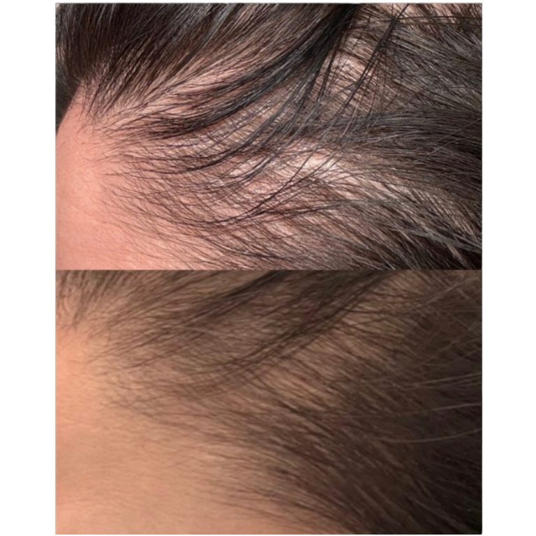 Female. Pro-Xo Premium Hair Exosomes. 3 Weeks Post-Microneedling Treatment #2