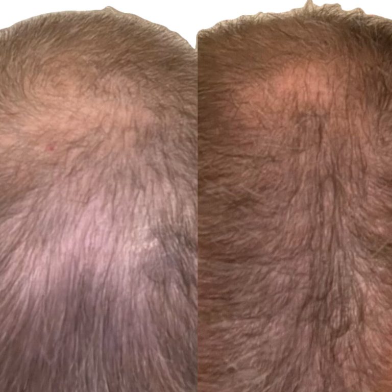 Male 61. Pro-Xo Premium Hair Exosomes. Four Weeks Post-2 Microneedling Treatments