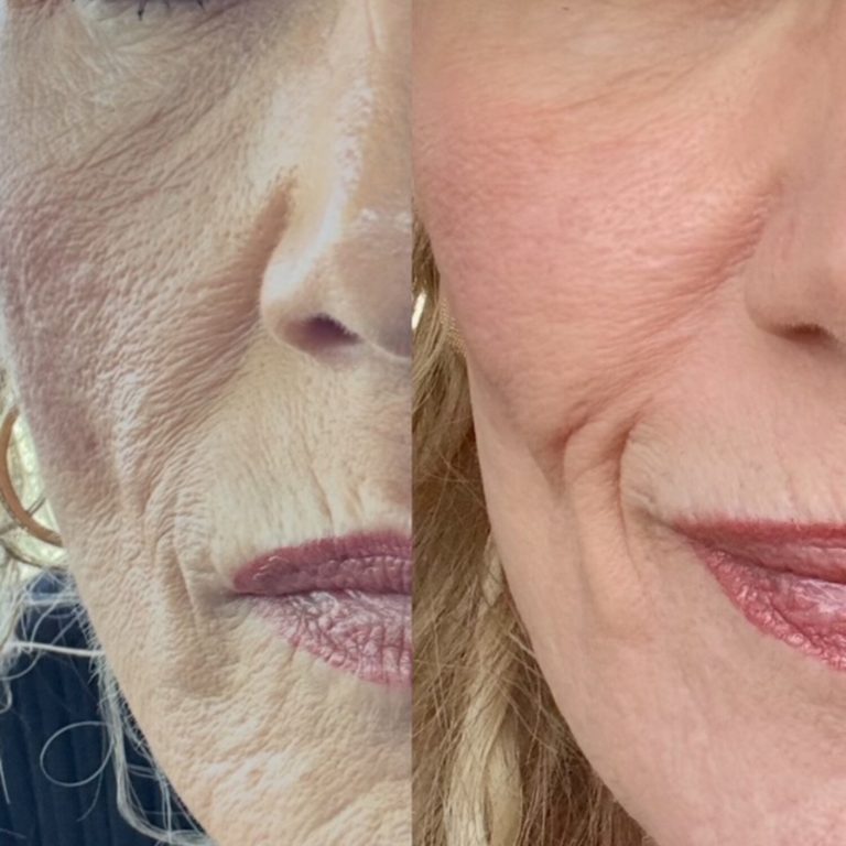 Pro-Xo Premium Skin Exosomes. 1 Microneedling Tx 4 weeks post (2)