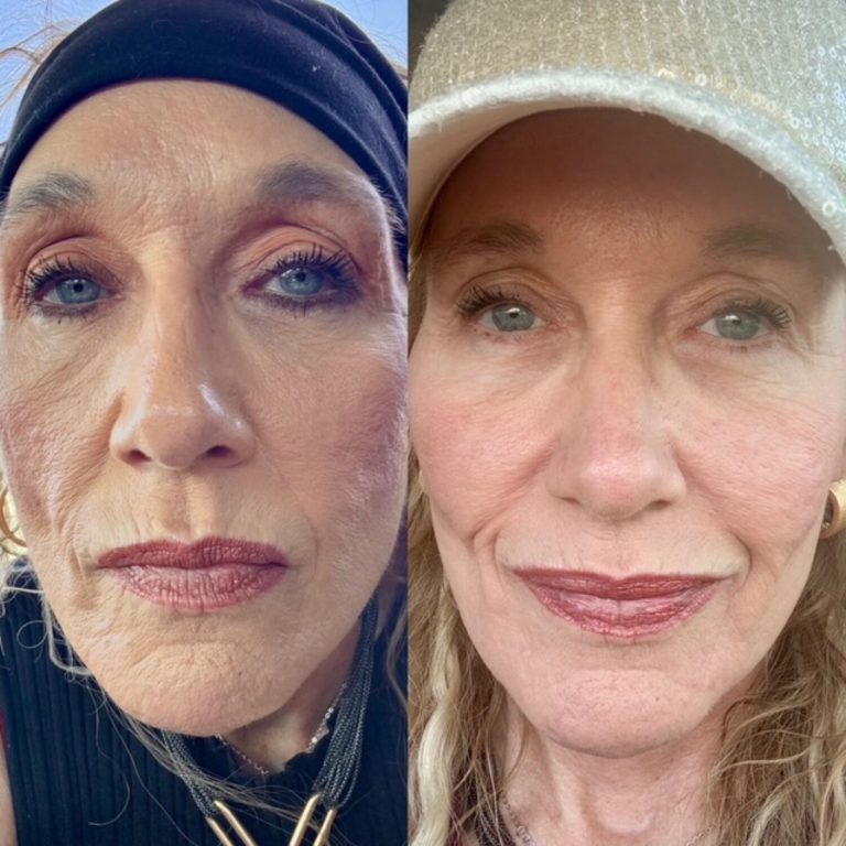 Pro-Xo Premium Skin Exosomes. 1 Microneedling Tx 4 weeks post